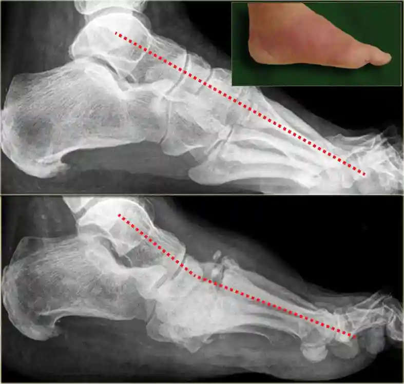 X-ray of Charcot foot