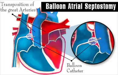 balloon-atrial-septostomy