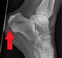 calcaneal fracture