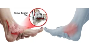 Read more about the article Tarsal Tunnel Syndrome