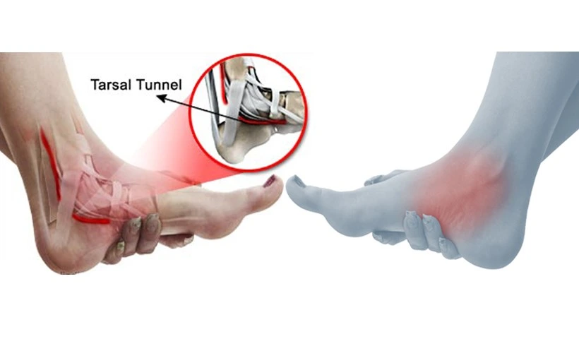 Tarsal Tunnel Syndrome