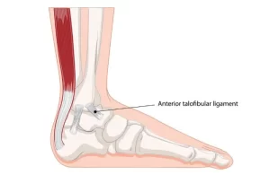 Read more about the article Anterior Talofibular Ligament (ATFL)