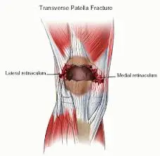 Patellar Retinaculum Injury