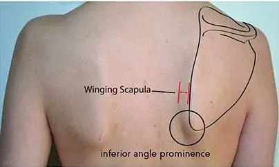 Scapular Dyskinesia