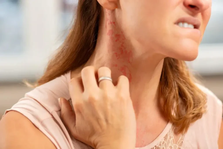 Allergic Reactions