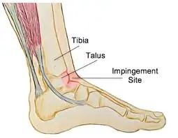 Anterior Ankle Impingement Syndrome