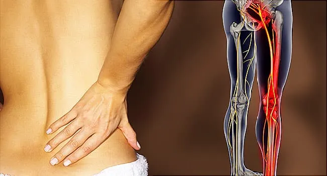 Can knee pain cause sciatica