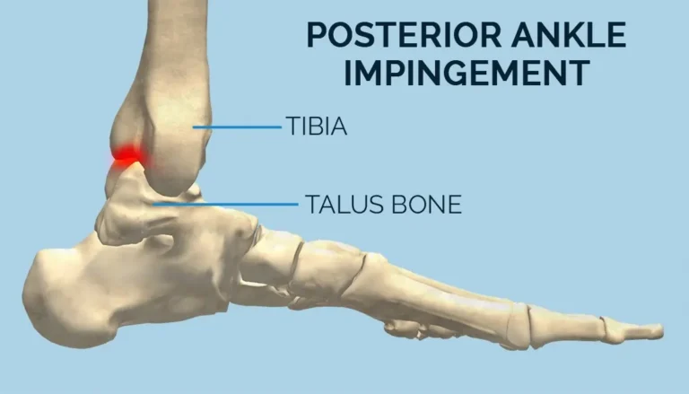 Posterior Ankle Impingement Syndrome