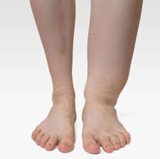 Swelling