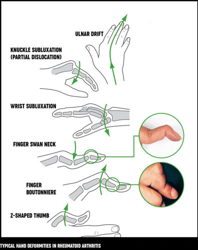 hand-deformities-