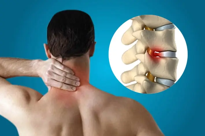 Cervical-spondylosis-and-myelopathy