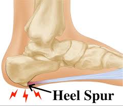 Heel Spurs