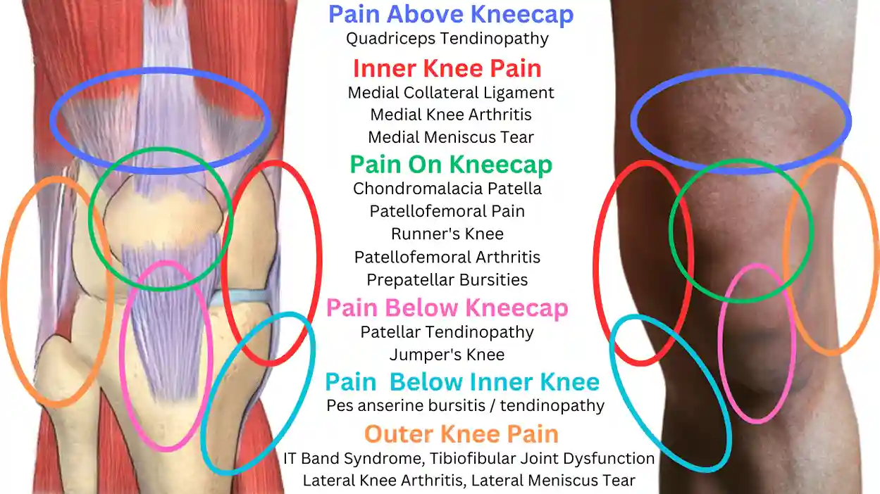 Knee-Pain-Location-Chart