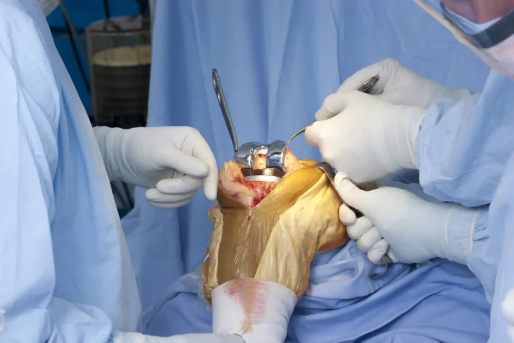 Understanding Knee Replacement Surgery