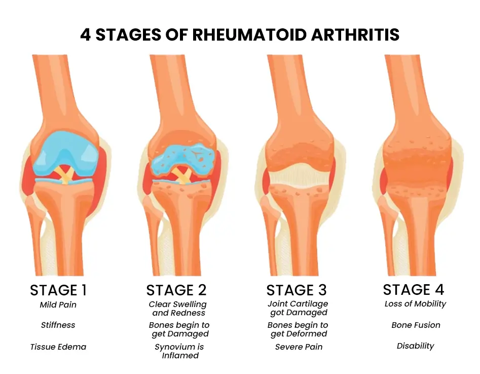 4 Stages of Rheumatoid Arthritis