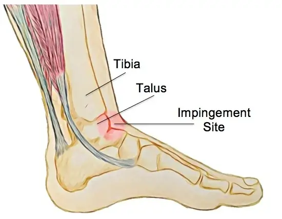 Anterior Ankle Impingement Syndrome