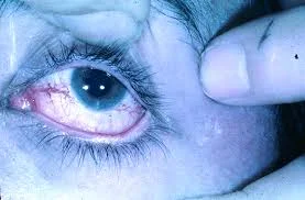 Ataxia-Telangiectasia