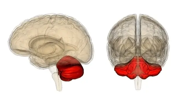 Autosomal Recessive Cerebellar Ataxia