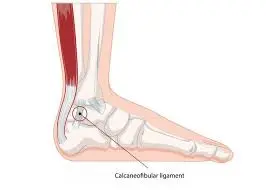 Calcaneofibular Ligament Injury