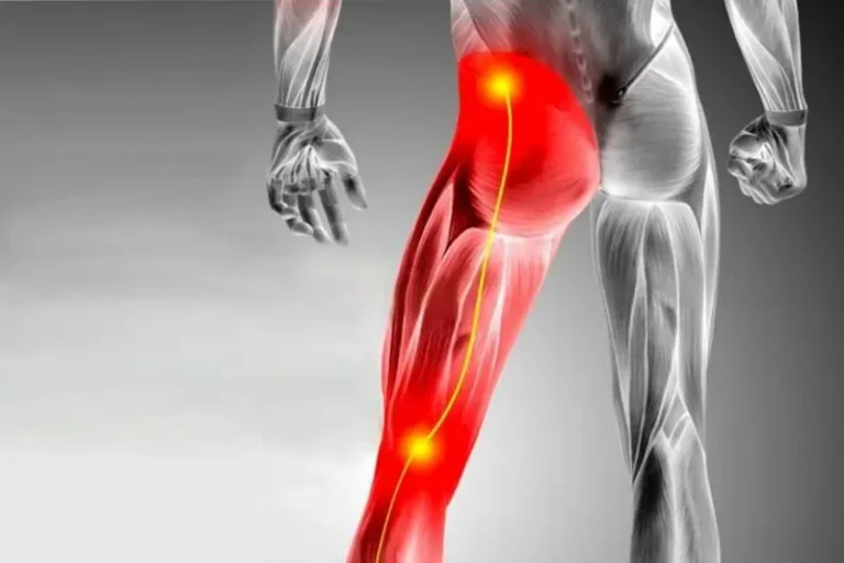 Can Knee Pain Cause Sciatica