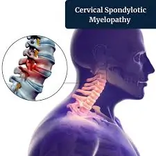 Cervical Spondylosis and Myelopathy