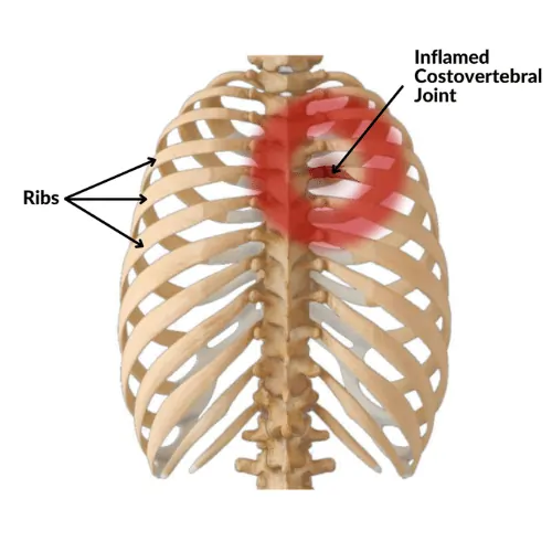 Costovertebral Dysfunction