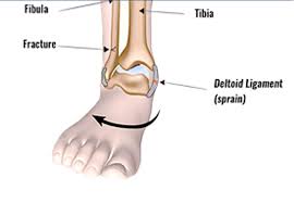 Deltoid Ligament Sprain