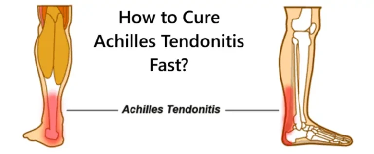 How to Cure Achilles Tendonitis Fast?