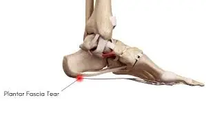 Plantar Fascia Tear