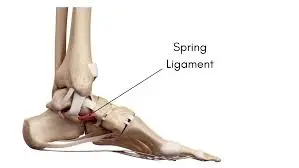 Spring Ligament Tear