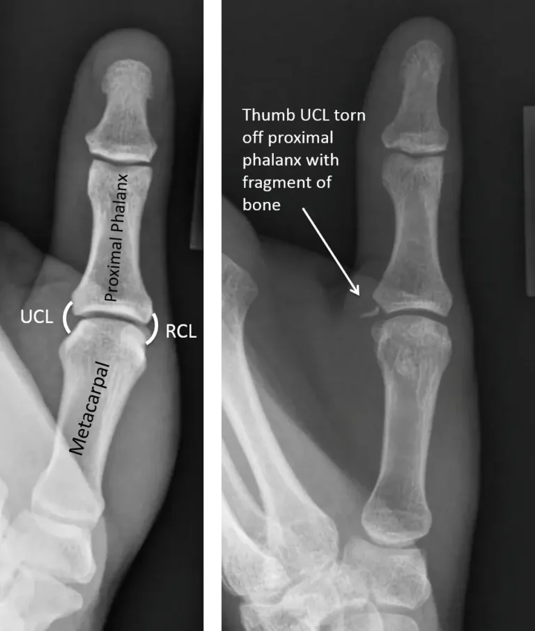 Thumb Collateral Ligament Injury