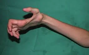 volkmanns-contracture