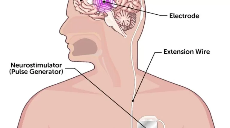 Deep-brain-stimulation-DBS