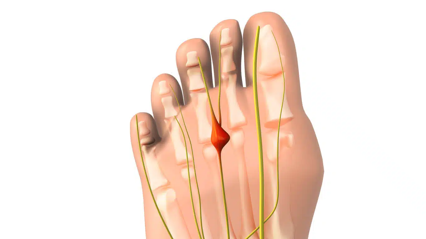Mortons neuroma