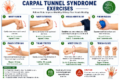 Carpal tunnel syndrome exercise