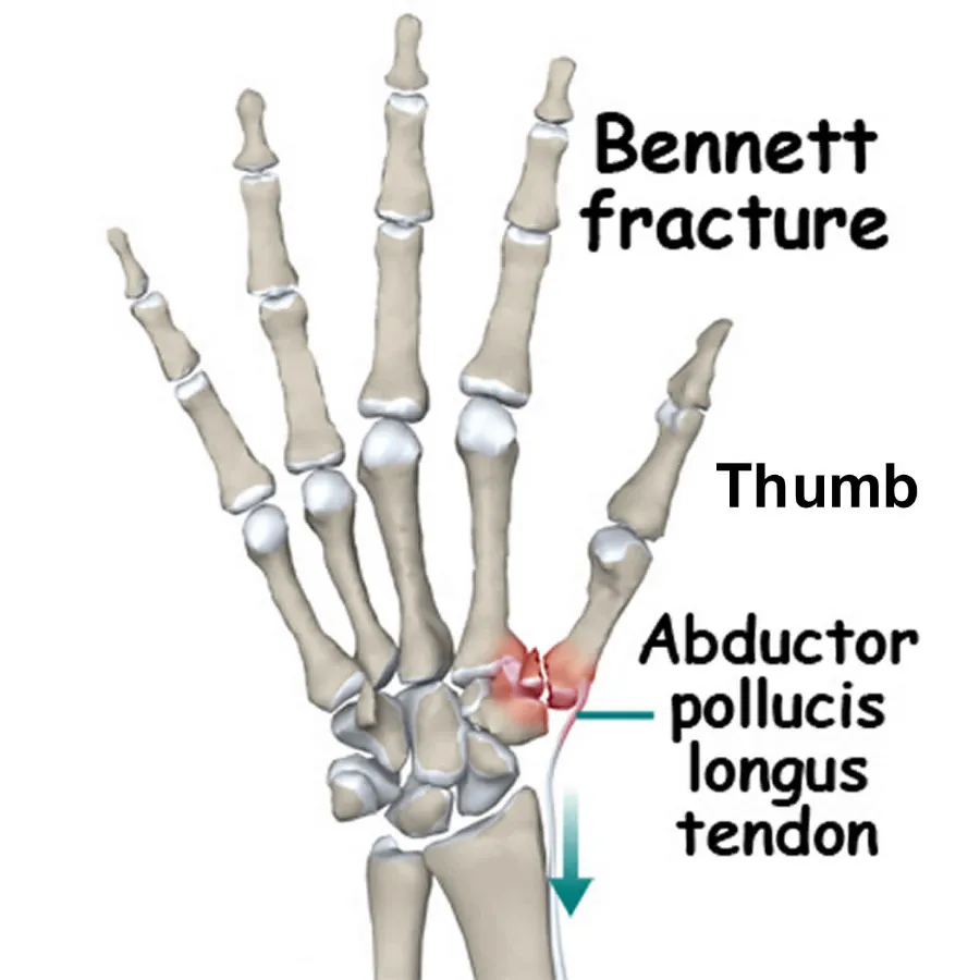 Bennett Fracture