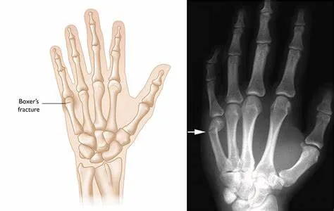 Boxer’s Fracture
